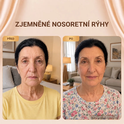 Zjemněné nosoretní rýhy